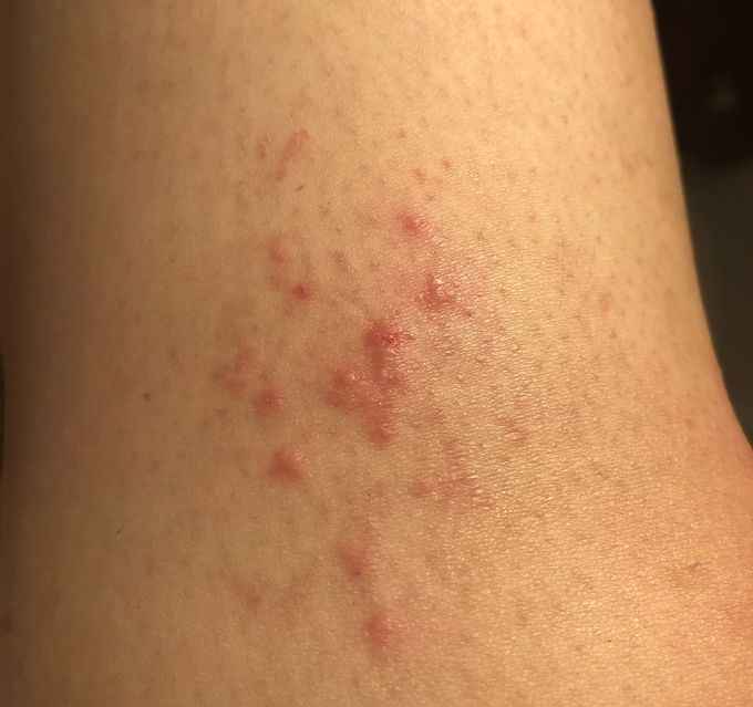 Rash on Leg MEDizzy