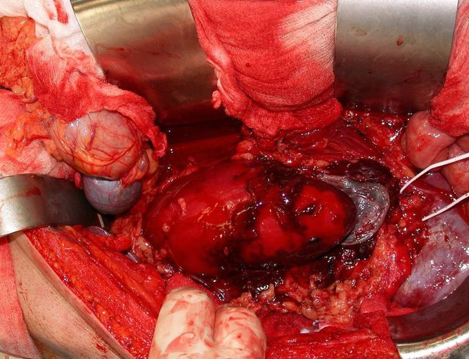 A severe kidney trauma with the kidney split apart after a motor vehicle accident
