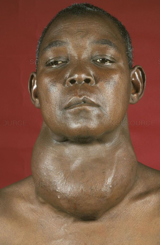 LIST OF THE COMPLICATIONS OF THE HYPOTHYROIDISM, This picture shows one of the complications of the hypothyroidism complications and its the goiter which is the ABNORMAL ENLARGEMENT OF THYROID GLAND)