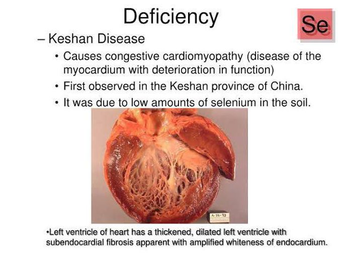 Keshan disease causes