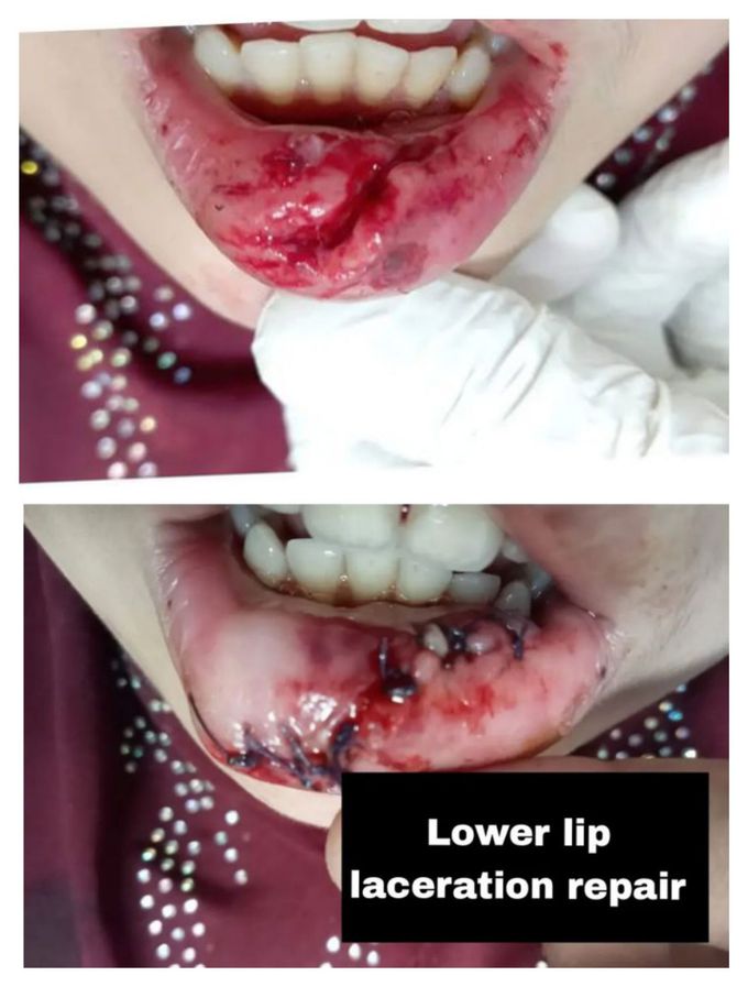 Lower Lip Laceration and Repair