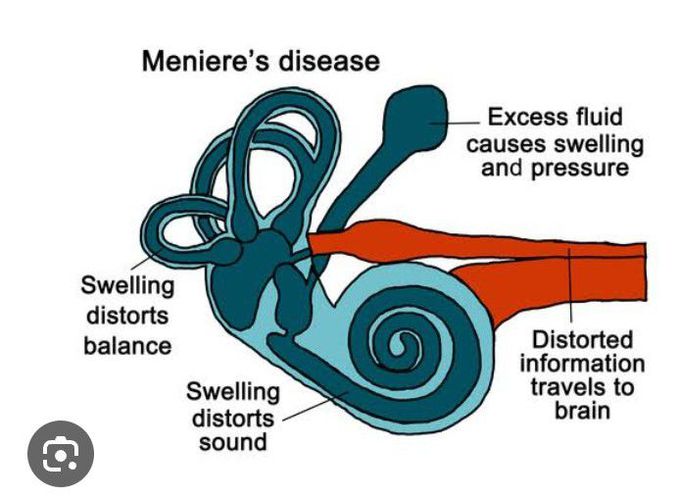 Meniers disease