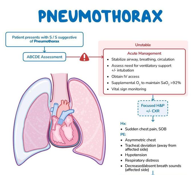 Pneumothorax