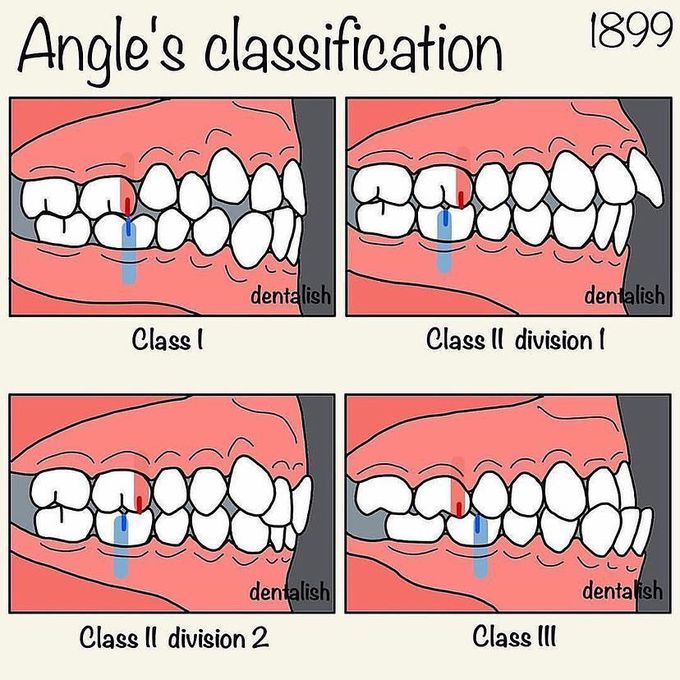 Angle's classification of occlusion