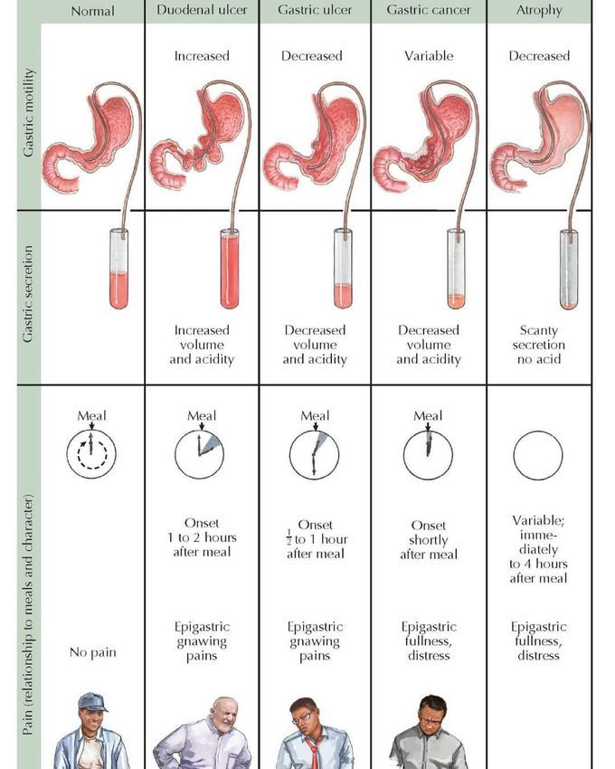 Gastric secretion and motility in different diseases