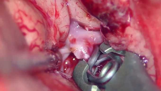 Brain Aneurysm Clipping