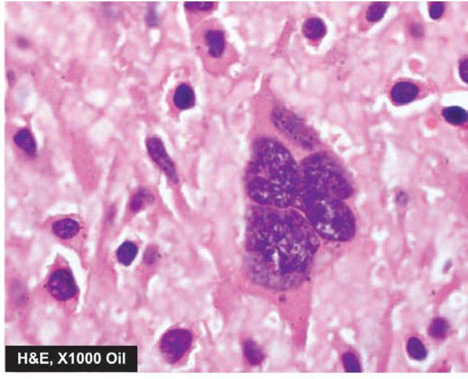 tumour giant cell