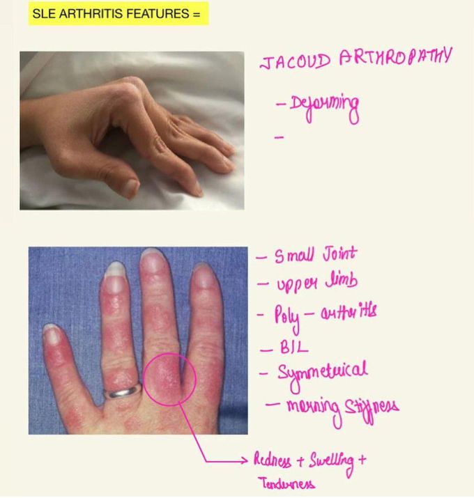 SLE- Arthritis