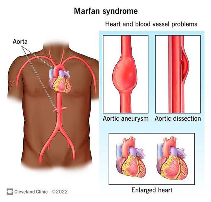 Marfan syndrome causes