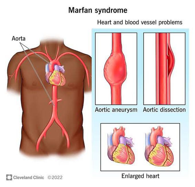 Marfan Syndrome Causes Medizzy 2230