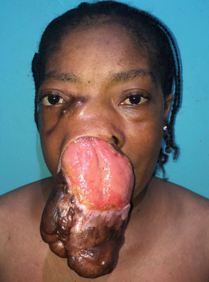 Cementifying Fibroma of right maxilla