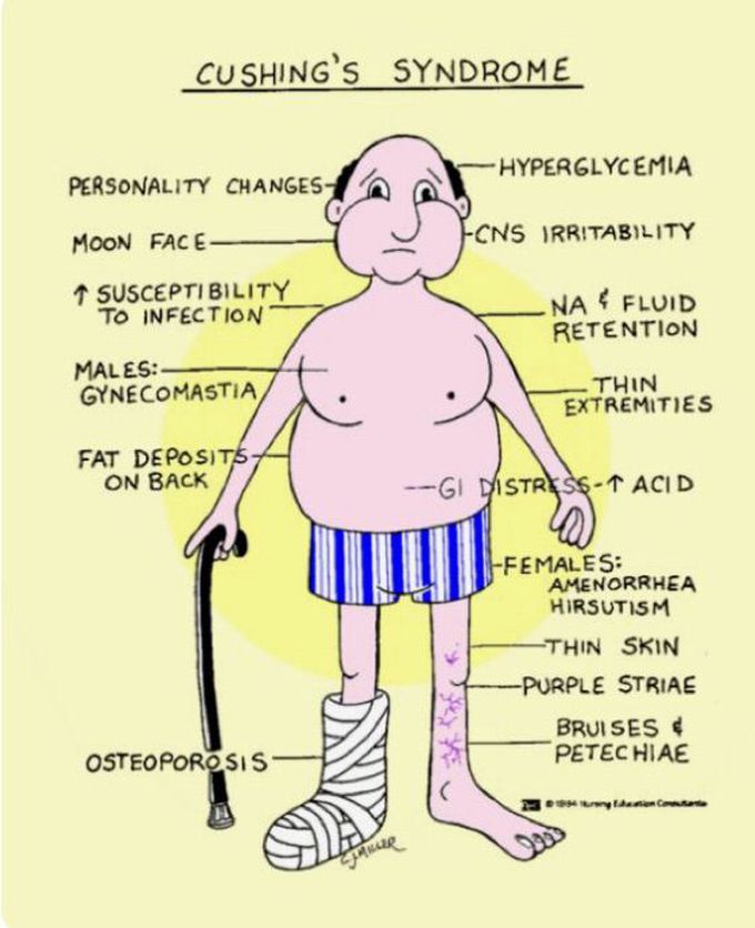 Cushing syndrome