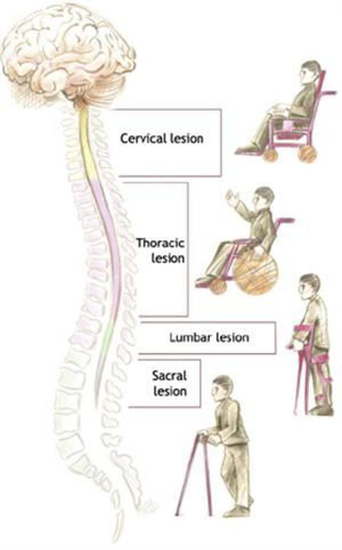 Picture to help remember spinal cord injury levels