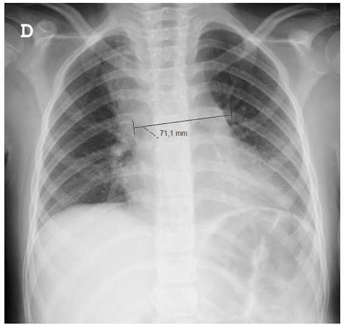 Mediastinitis