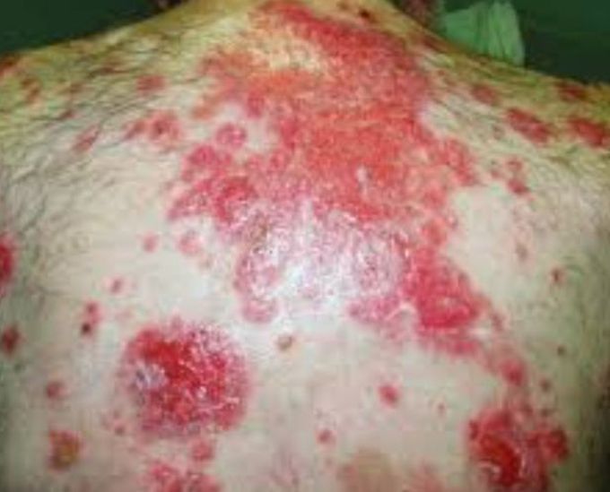 Pemphigus Vulgaris