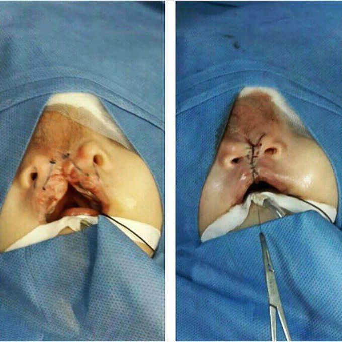 Bifid nose