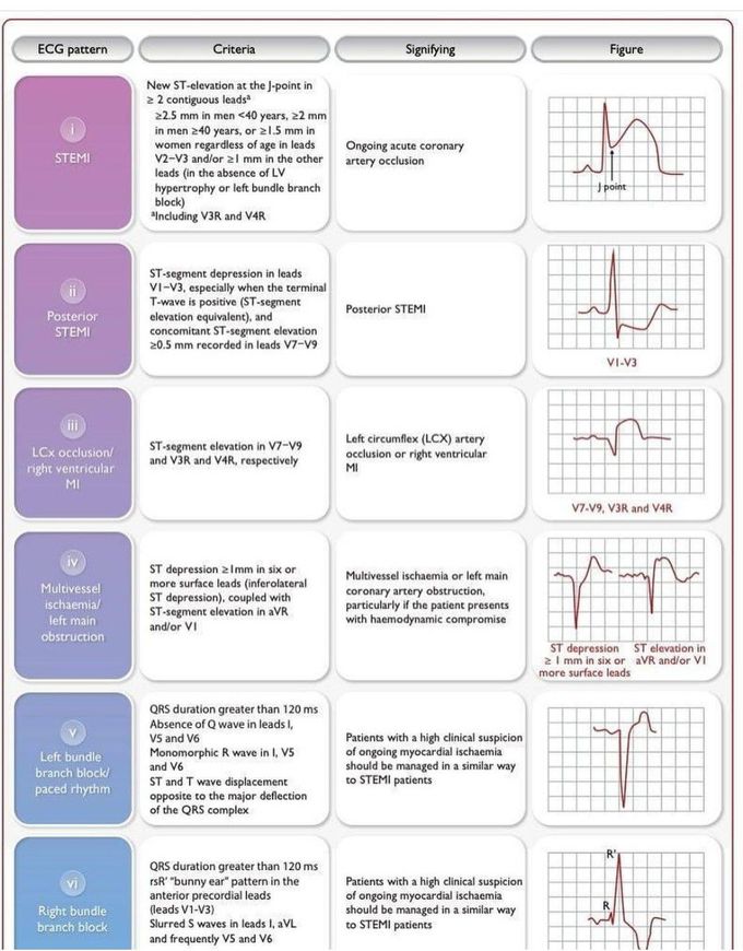 ECG Patterns
