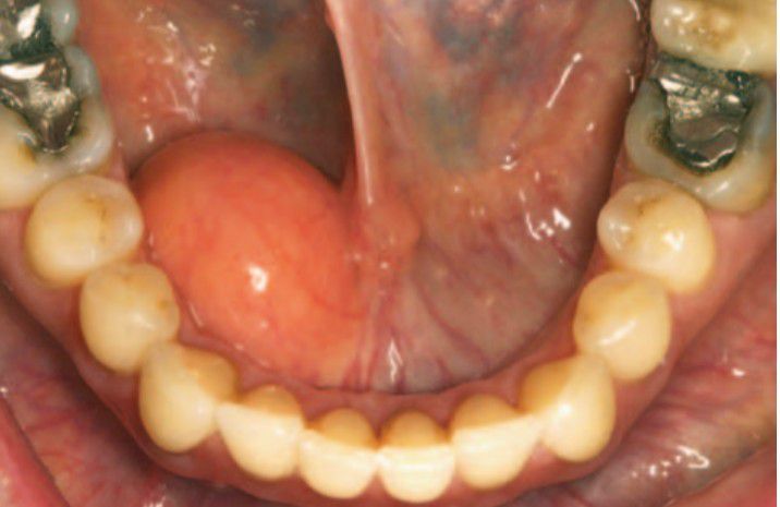 LIPOMA OF THE FLOOR OF MOUTH