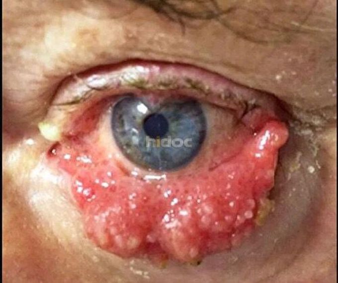 conjunctival papilloma treatment