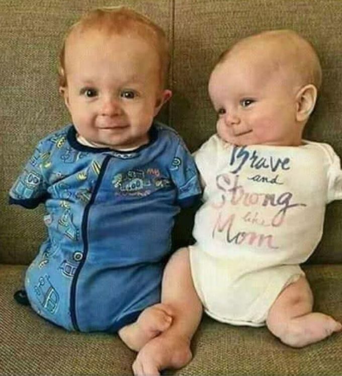 Two babies born without arms of legs😍