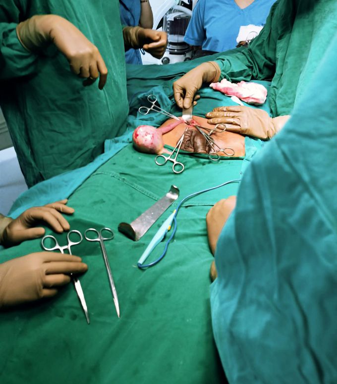Testicular tumor resection!