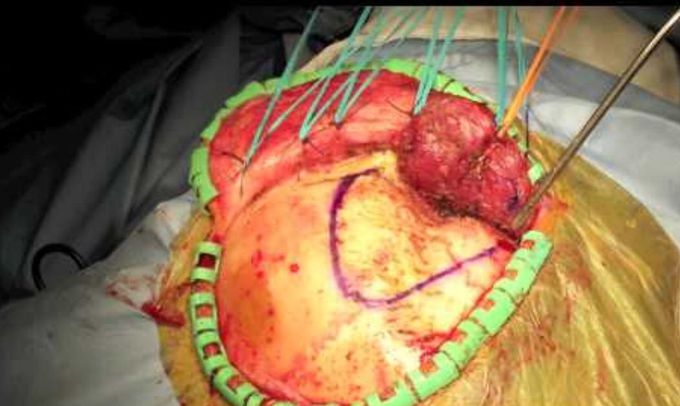 Neurosurgery