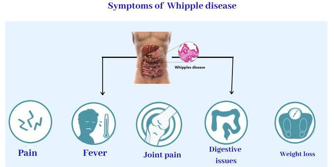 Symptoms of Whipple disease