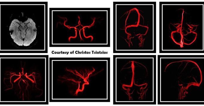 High-resolution Angiography