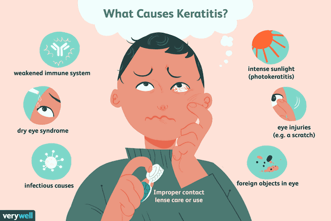 Keratitis- Causes