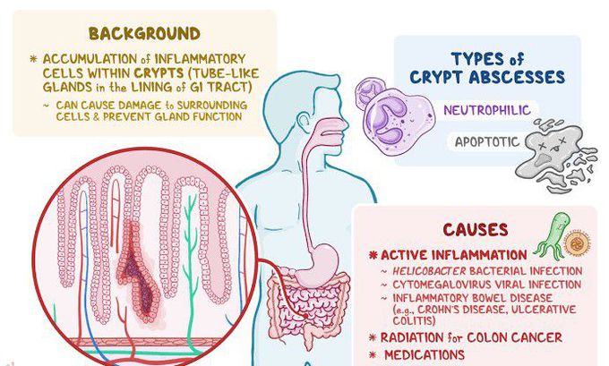 Crypt abscess