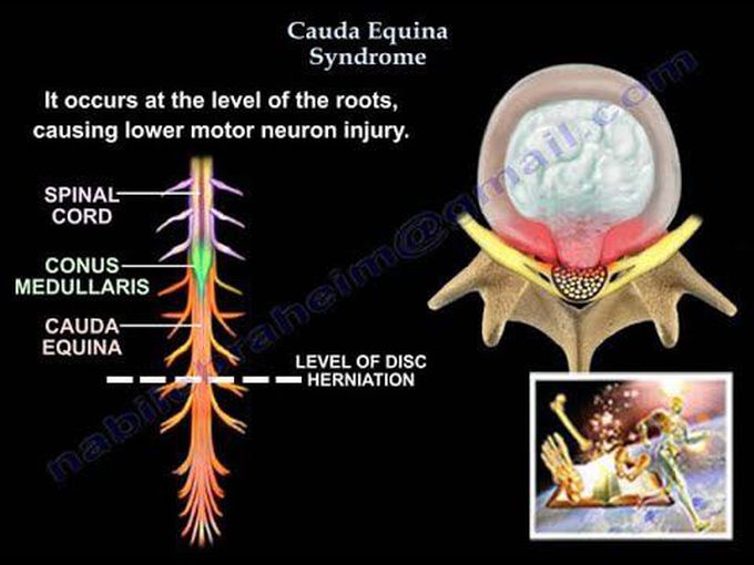 Cauda Equina Syndrome: Introduction