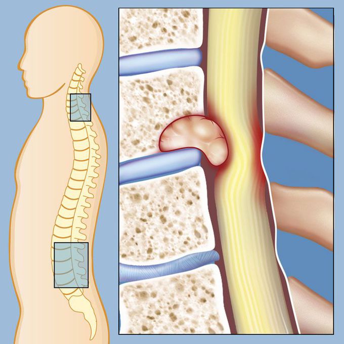 Causes of Spinal tumor