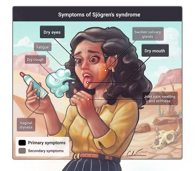 Symptoms of Sjogren Syndrome