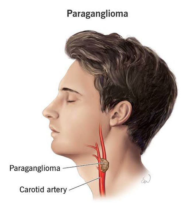 Visual representation of Paraganglioma