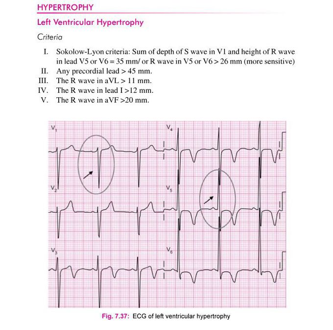 How to dx left ventricular hypertrophy ?