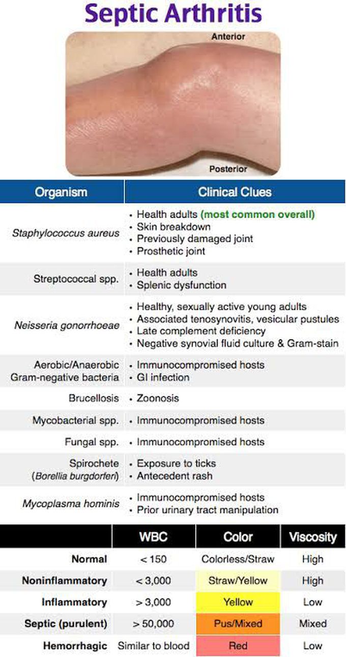 Septic Arthritis