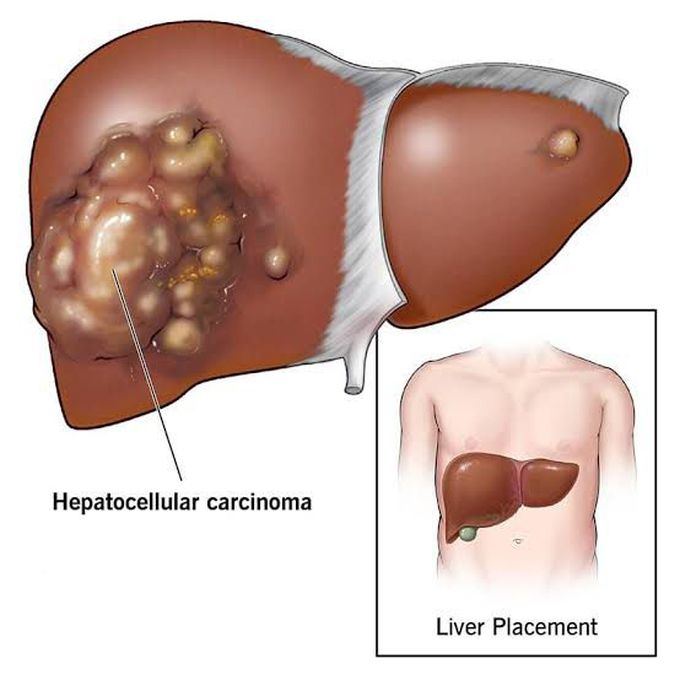This is the visual representation of Hepatocellular carcinoma