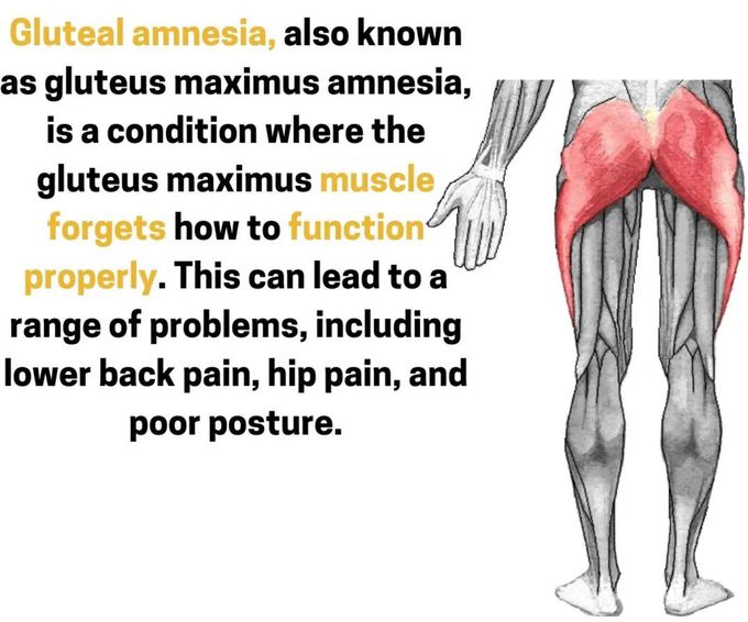 Gluteal Amnesia I