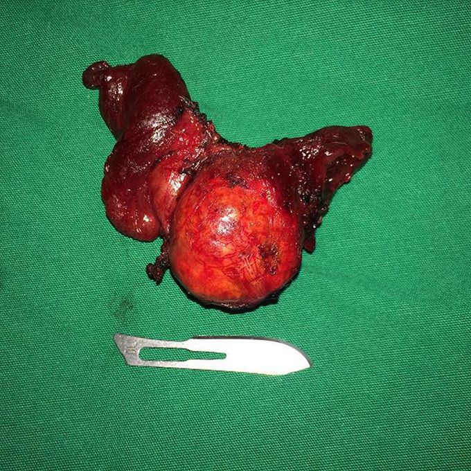 Thyroid cancer post total thyroidectomy 