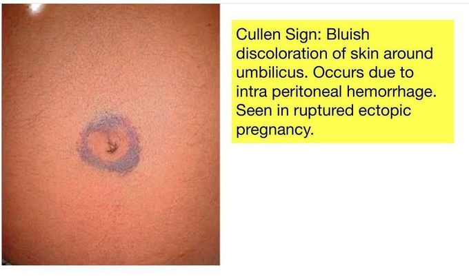 Cullen Sign