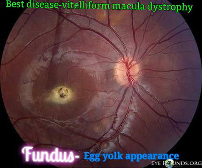 Best disease