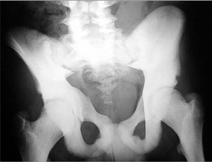 Osteopetrosis