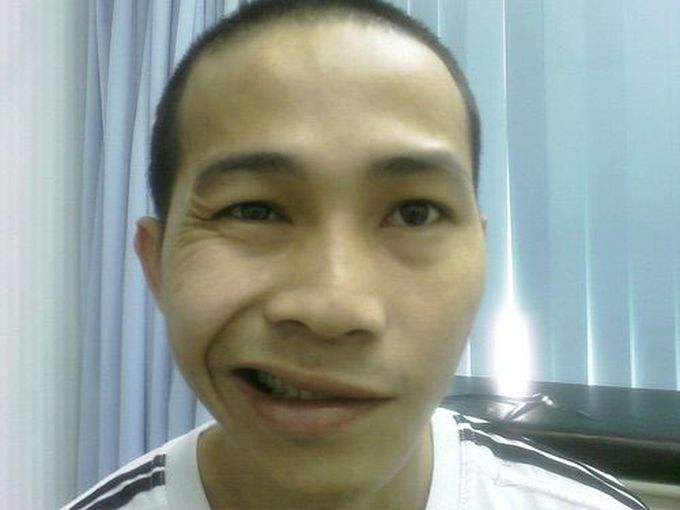 Fascial palsy