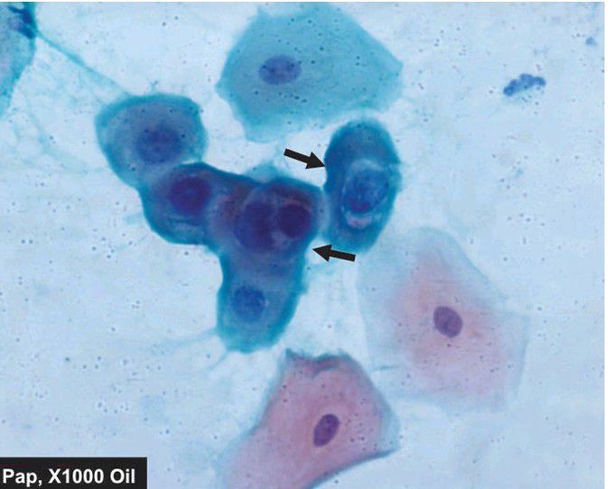 Low-grade squamous intraepithelial lesion (L-SIL)