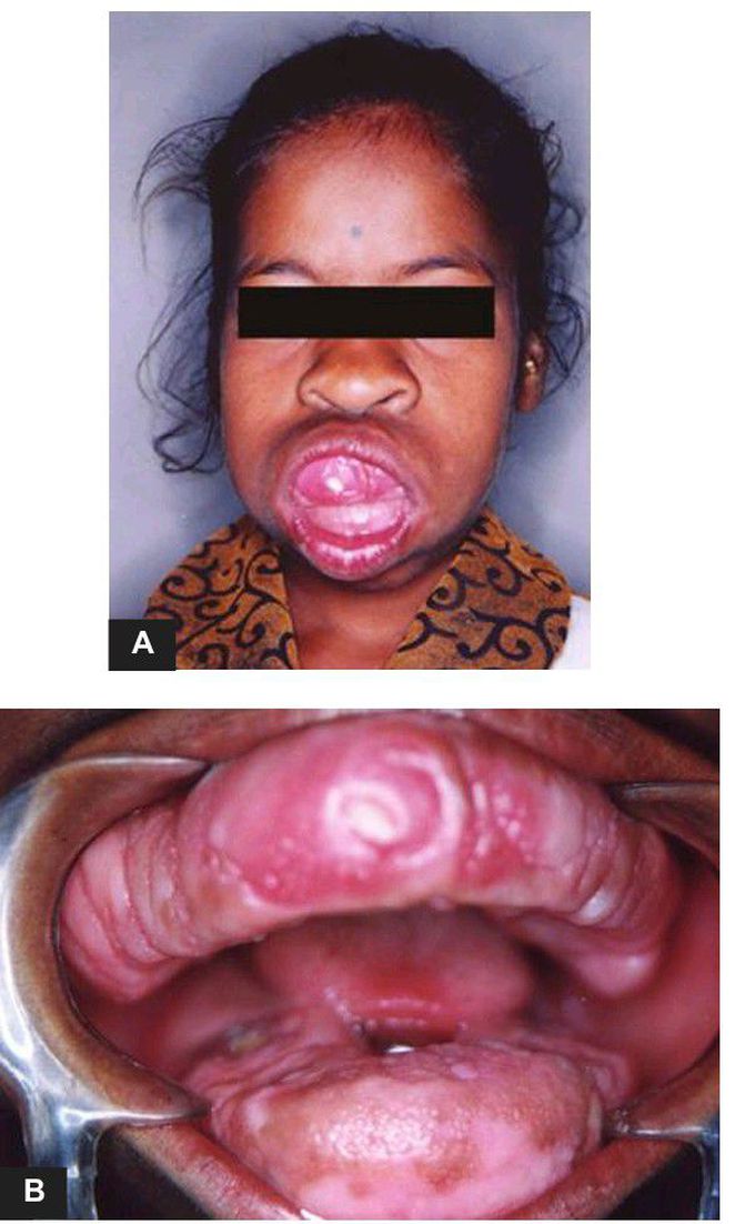 Fibromatosis gingiva