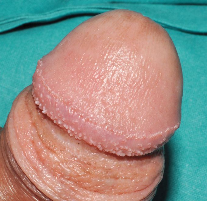 Pearly Penile Papules