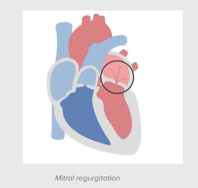 Mitral regurgitation