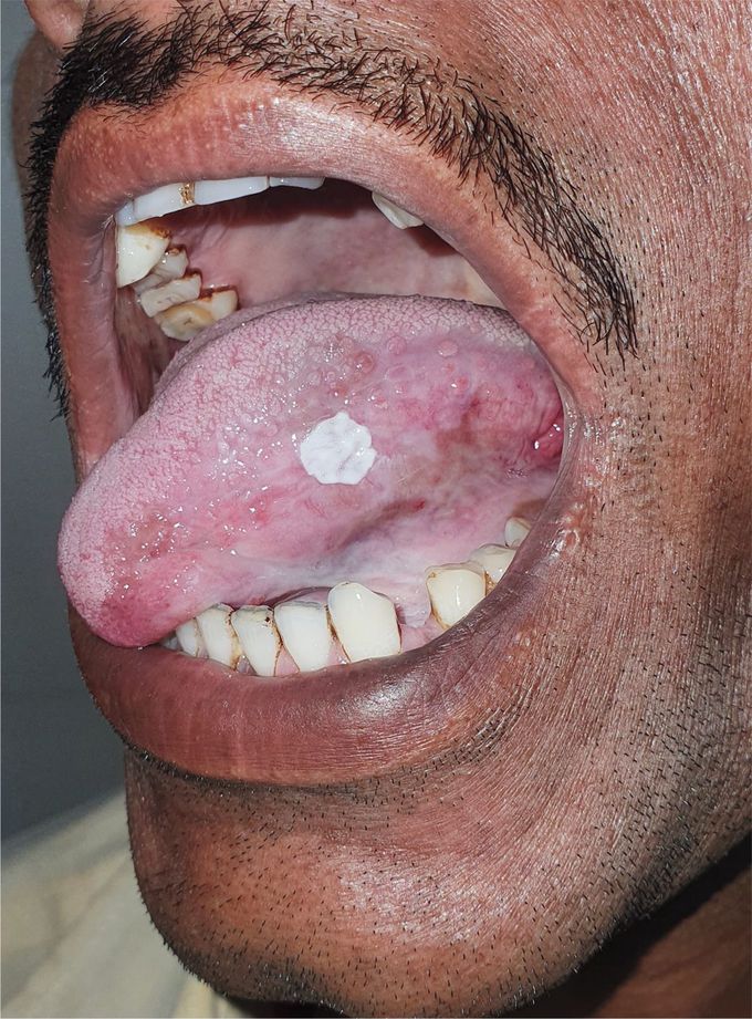 White Plaque on the Tongue