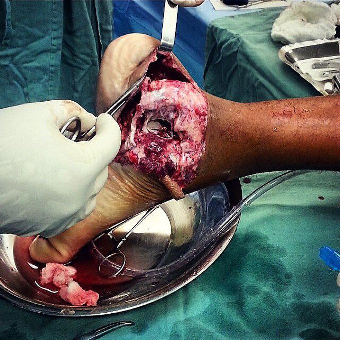 Foot injury following a car accident!