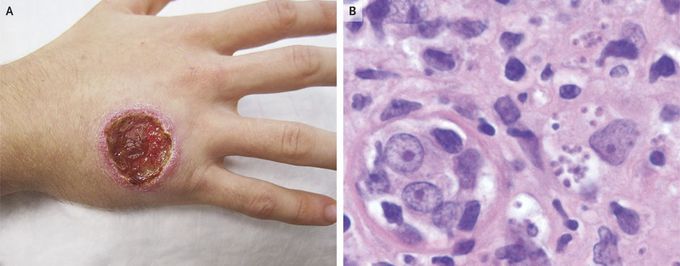Cutaneous Leishmaniasis